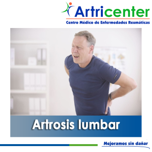 Artricenter: Artrosis lumbar