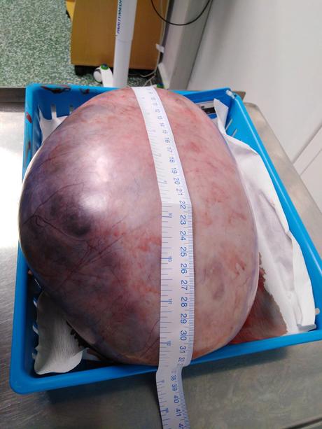 Mujer creía estar embarazada pero le sacaron un tumor de 4 kilos