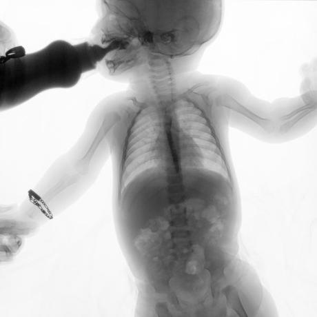 SERIE ESOFAGOGASTRODUODENAL CON MECANICA DE LA DEGLUCION SERIE ESOFAGOGASTRODUODENAL CON MECANICA DE LA DEGLUCION