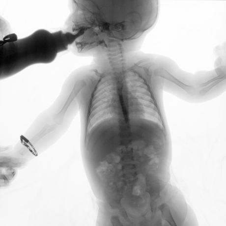 SERIE ESOFAGOGASTRODUODENAL CON MECANICA DE LA DEGLUCION SERIE ESOFAGOGASTRODUODENAL CON MECANICA DE LA DEGLUCION