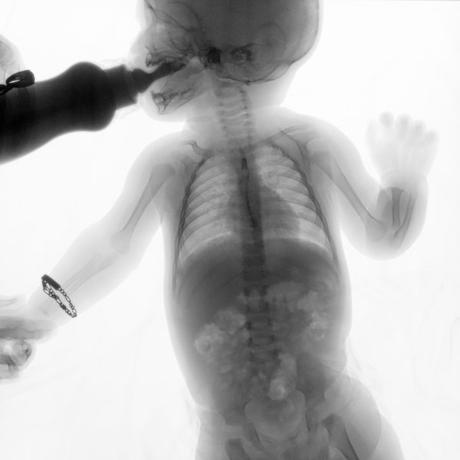 SERIE ESOFAGOGASTRODUODENAL CON MECANICA DE LA DEGLUCION SERIE ESOFAGOGASTRODUODENAL CON MECANICA DE LA DEGLUCION