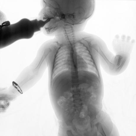 SERIE ESOFAGOGASTRODUODENAL CON MECANICA DE LA DEGLUCION SERIE ESOFAGOGASTRODUODENAL CON MECANICA DE LA DEGLUCION