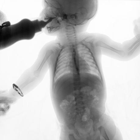 SERIE ESOFAGOGASTRODUODENAL CON MECANICA DE LA DEGLUCION SERIE ESOFAGOGASTRODUODENAL CON MECANICA DE LA DEGLUCION