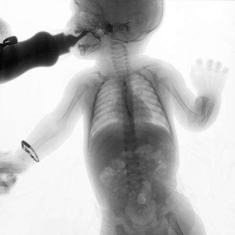 SERIE ESOFAGOGASTRODUODENAL CON MECANICA DE LA DEGLUCION SERIE ESOFAGOGASTRODUODENAL CON MECANICA DE LA DEGLUCION