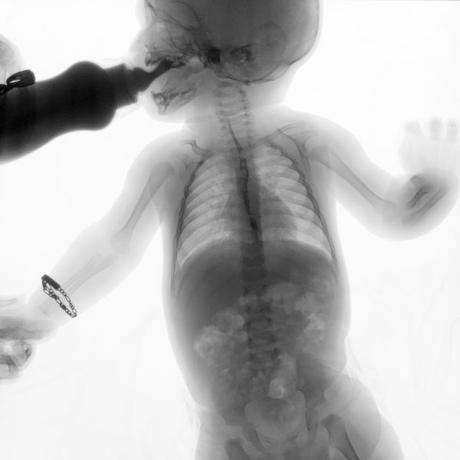 SERIE ESOFAGOGASTRODUODENAL CON MECANICA DE LA DEGLUCION SERIE ESOFAGOGASTRODUODENAL CON MECANICA DE LA DEGLUCION