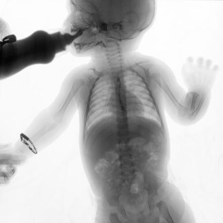 SERIE ESOFAGOGASTRODUODENAL CON MECANICA DE LA DEGLUCION SERIE ESOFAGOGASTRODUODENAL CON MECANICA DE LA DEGLUCION