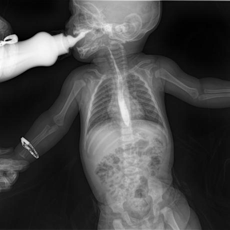 SERIE ESOFAGOGASTRODUODENAL CON MECANICA DE LA DEGLUCION