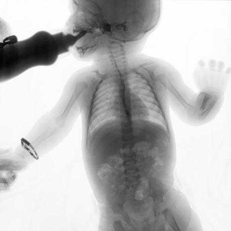 SERIE ESOFAGOGASTRODUODENAL CON MECANICA DE LA DEGLUCION SERIE ESOFAGOGASTRODUODENAL CON MECANICA DE LA DEGLUCION