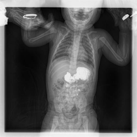 SERIE ESOFAGOGASTRODUODENAL CON MECANICA DE LA DEGLUCION SERIE ESOFAGOGASTRODUODENAL CON MECANICA DE LA DEGLUCION