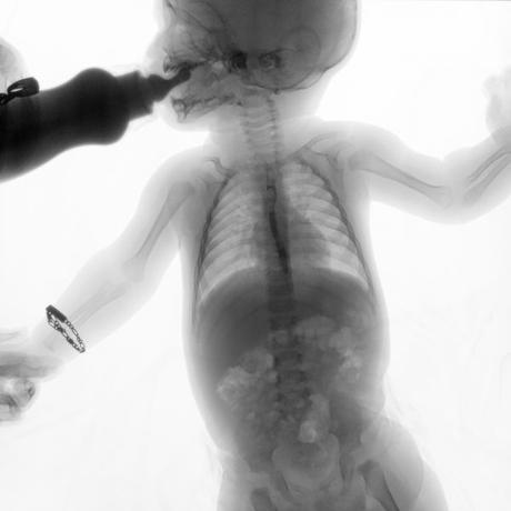 SERIE ESOFAGOGASTRODUODENAL CON MECANICA DE LA DEGLUCION SERIE ESOFAGOGASTRODUODENAL CON MECANICA DE LA DEGLUCION