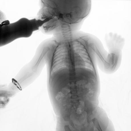 SERIE ESOFAGOGASTRODUODENAL CON MECANICA DE LA DEGLUCION SERIE ESOFAGOGASTRODUODENAL CON MECANICA DE LA DEGLUCION