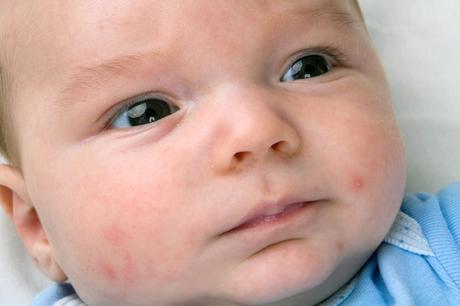 ¿Qué causa la piel seca en la cara de un bebé?
