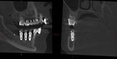 La técnica de regeneración ósea guiada revoluciona la colocación de los implantes dentales cuando falta hueso según CSD La técnica de regeneración ósea guiada revoluciona la colocación de los implantes dentales cuando falta hueso según CSD