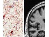 Encefalopatía TDP-43 predominio límbico asociada edad: informe consenso grupo trabajo.