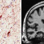 Encefalopatía TDP-43 de predominio límbico asociada a la edad: informe de consenso del grupo de trabajo.
