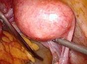 importancia Cirugía para Cáncer Ovario