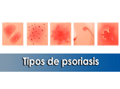 Artricenter: Tipos psoriasis