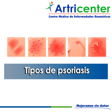 Artricenter: Tipos de psoriasis