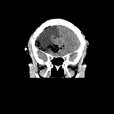 Corte coronal post quirúrgico, adecuada resección de lesión. Coronal CT scan, showing a proper tumor resection