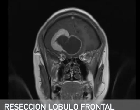 Glioma de alto grado