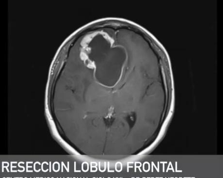 Glioma de alto grado