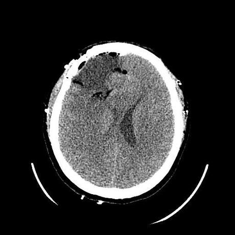 Corte axial post quirúrgico, adecuada resección de lesión. Axial CT scan, showing a proper tumor resection