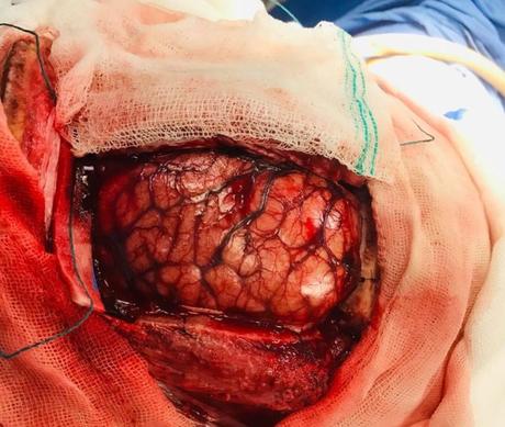 Glioma de alto grado