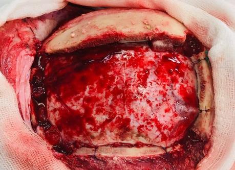 Glioma de alto grado