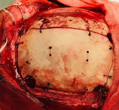 Glioma de alto grado