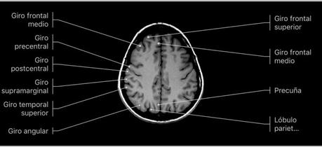 Glioma de alto grado