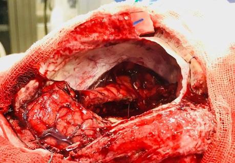 Glioma de alto grado