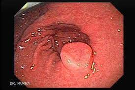 La Esofagitis Eosinofilica
