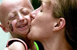 Un equipo de la Universidad de Oviedo identifica una forma de progeria tras secuenciar el genoma en dos pacientes