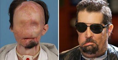 El Hombre que recibió el primer trasplante  de cara aparece en público