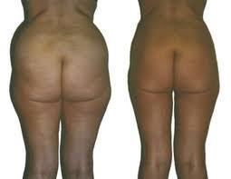 La grasa vuelve a acumularse después de la liposucción