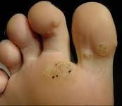 Las Verrugas Plantares