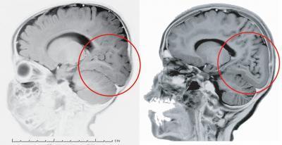 Otro responsable del desarrollo de nuestro cerebro