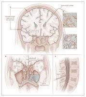 Meningitis bacteriana nosocomial