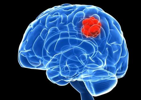 Tipos de tumores en el cerebro
