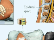 Fidel Pagés Marivé, descubridor anestesia epidural