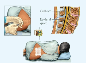 Fidel Pagés Marivé, descubridor de la anestesia epidural