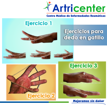 Artricenter: Ejercicios para dedo en gatillo