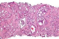 Bloqueando una Proteína se detiene la Propagación del Cáncer