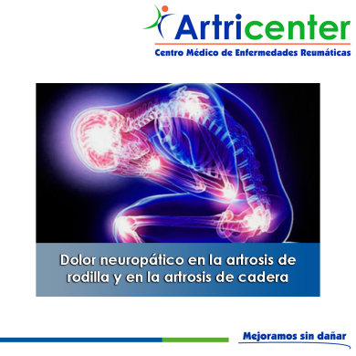 Artricenter: Dolor neuropático en la artrosis de rodilla y en la artrosis de cadera