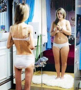 anorexia psicologos malaga
