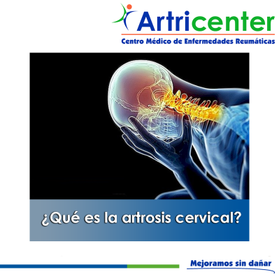 Artricenter: ¿Qué es la artrosis cervical? Artricenter: ¿Qué es la artrosis cervical?
