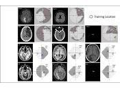 Estimulación Cerebral invasiva mejora Aprendizaje
