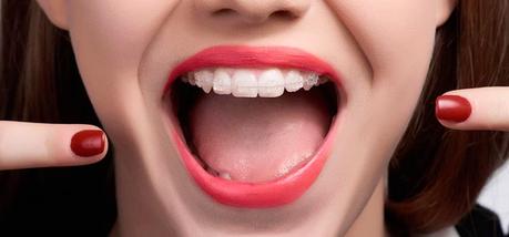 Qué tipo de ortodoncia invisible es mejor