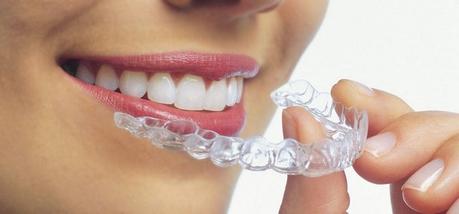 Tipos de ortodoncia invisible