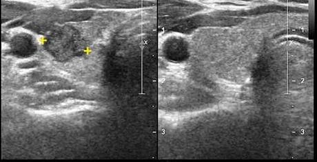 Nódulo tiroideo sólido, en un corte transversal, adyacente a la arteria carótida común, de contornos microlobulados, hipoecogénico y heterogéneo. (Ca papilar).